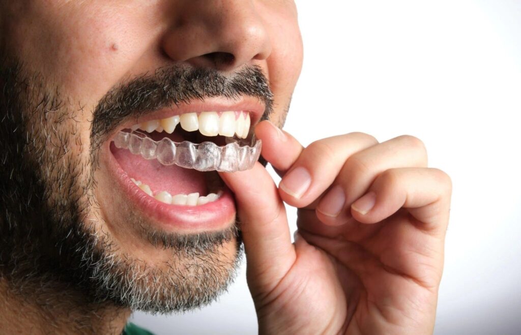 dental invisalign in Agoura Hills